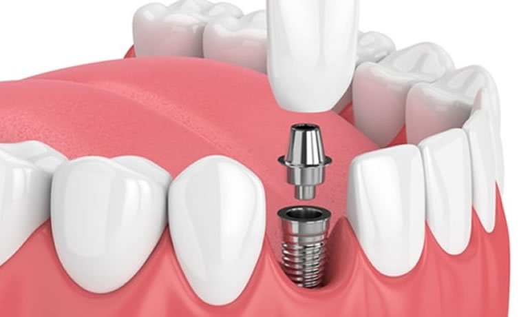 Cirurgia de Implante Dentário​